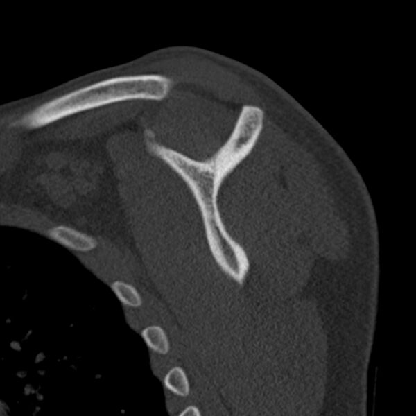 File:Bankart lesion (Radiopaedia 22771-22798 Sagittal bone window 40).jpg