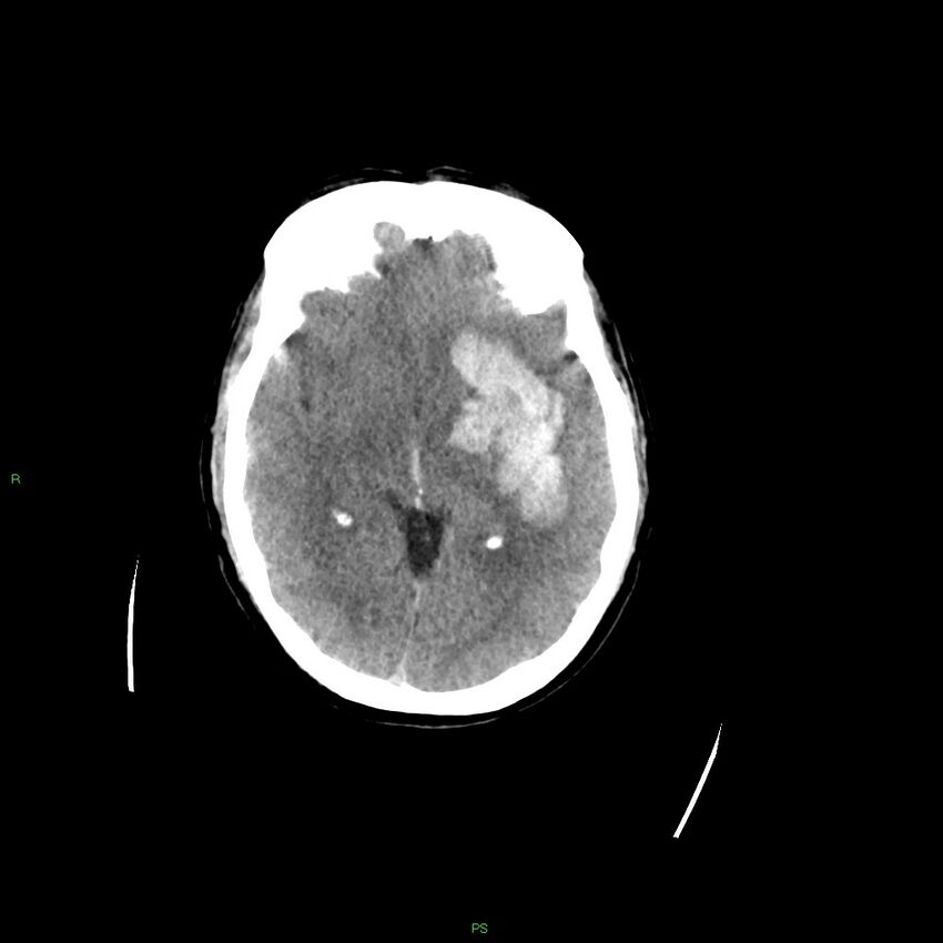 Basal ganglia hemorrhage (Radiopaedia 58349-65472 Axial non-contrast 33).jpg