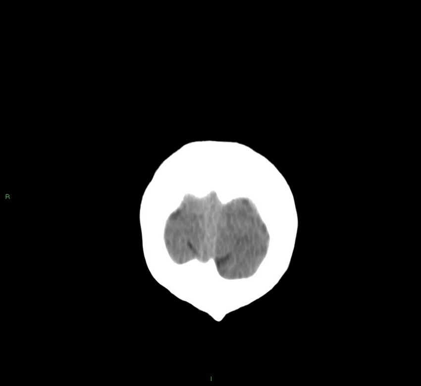 Basal ganglia hemorrhage (Radiopaedia 58767-65989 Coronal non-contrast 7).jpg