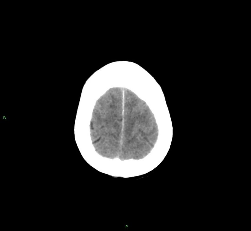 Basal ganglia hemorrhage (Radiopaedia 58775-66008 Axial non-contrast 12).jpg