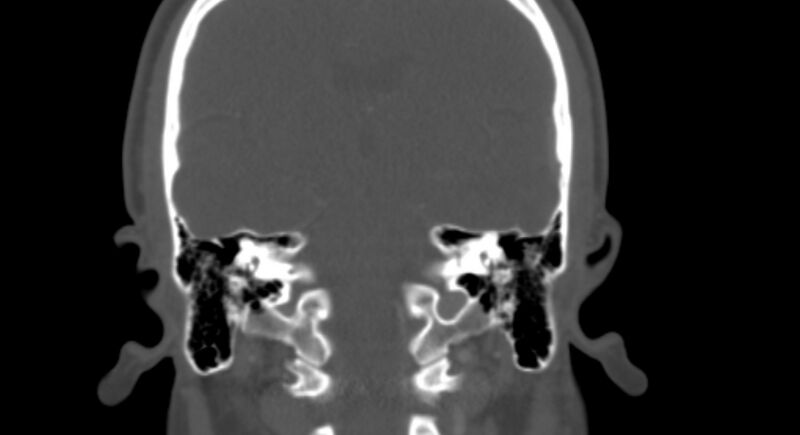 File:Benign mixed salivary tumor of the parotid gland (Radiopaedia 35261-36792 Coronal bone window 22).jpg