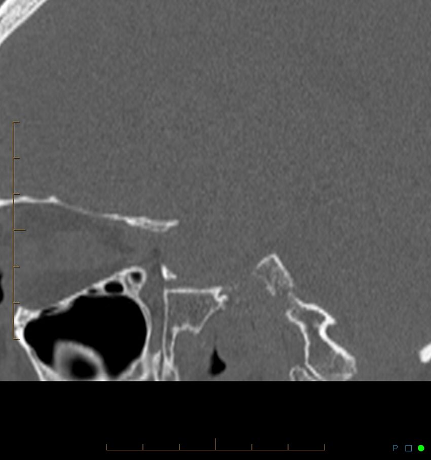 Benign notochordal cell tumor (probable) (Radiopaedia 65475-74546 Sagittal bone window 43).jpg