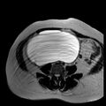 Benign seromucinous cystadenoma of the ovary (Radiopaedia 71065-81300 B 20).jpg