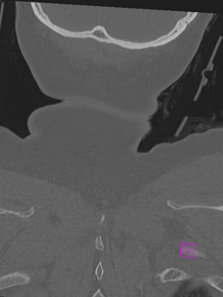 File:Bilateral atlanto-occipital assimilation (Radiopaedia 28350-28603 Coronal bone window 55).jpg