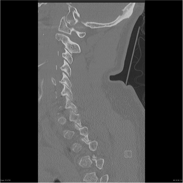 File:Bilateral cervical ribs (Radiopaedia 25868-26017 Sagittal bone window 23).jpg