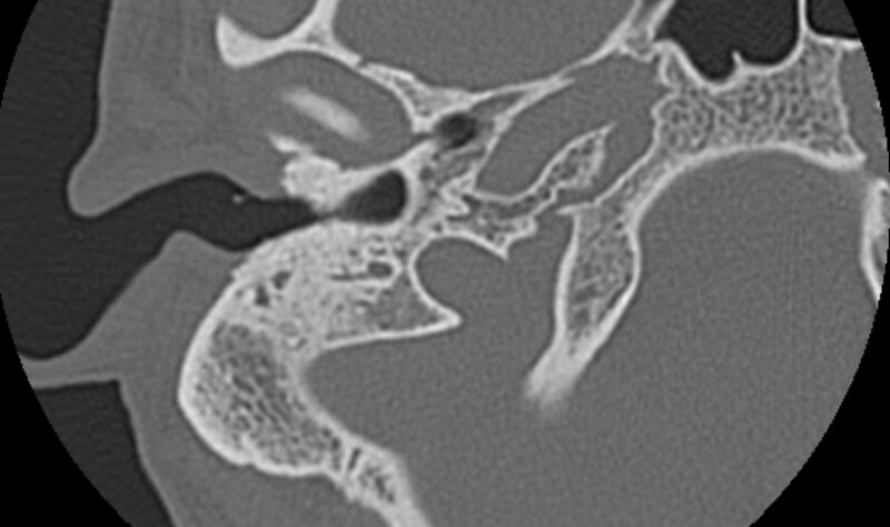 File:Bilateral cholesteatoma (Radiopaedia 54898-61172 Axial bone window 7).jpg