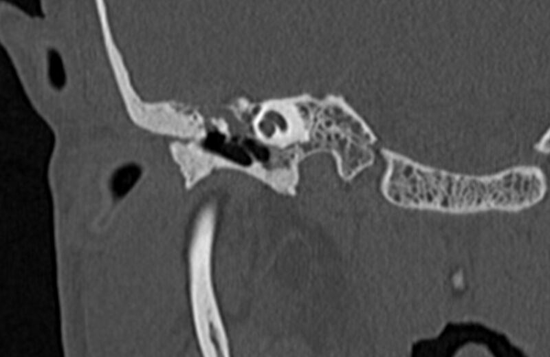 File:Bilateral cholesteatoma (Radiopaedia 54898-61172 Coronal bone window 25).jpg