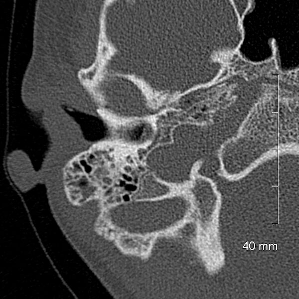 File:Bilateral grommets (Radiopaedia 47710-52404 Axial bone window 21).jpg