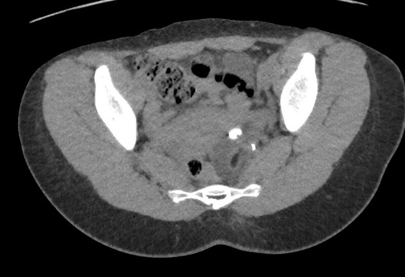 File:Bilateral mature cystic ovarian teratoma (Radiopaedia 88821-105592 Axial non-contrast 18).jpg