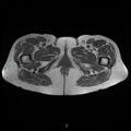 Bilateral ovarian fibroma (Radiopaedia 44568-48293 Axial T1 32).jpg