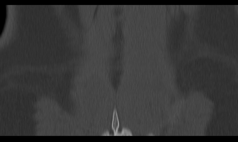 File:Bilateral pars defect (Radiopaedia 26691-26846 Coronal bone window 48).jpg