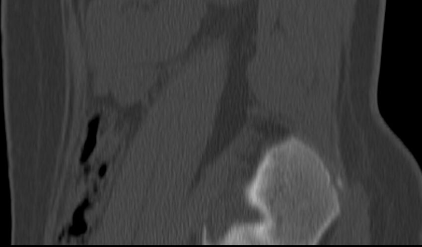 Bilateral pars defect (Radiopaedia 26691-26846 Sagittal bone window 5).jpg
