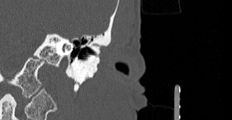 File:Bilateral temporal bone fractures (Radiopaedia 29482-29970 B 15).jpg