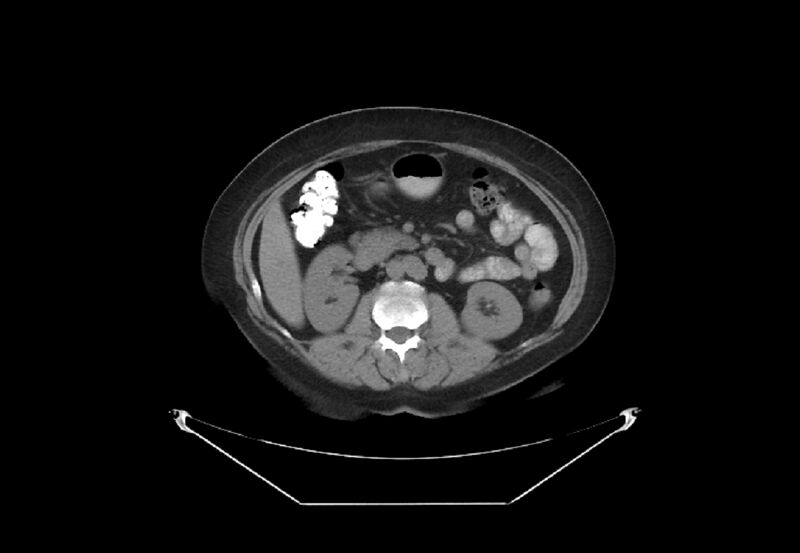 File:Bilateral urolithiasis with incidentally detected splenic artery aneurysm and left inferior vena cava (Radiopaedia 44467-48123 Axial non-contrast 23).jpg