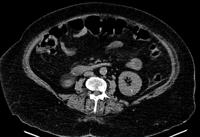 File:Biliary pancreatitis (Radiopaedia 72289-82823 Axial non-contrast 140).jpg
