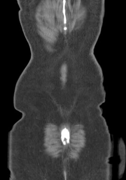 File:Bleeding duodenal ulcer and adenomyomatosis of gallbladder (Radiopaedia 61834-69861 B 3).jpg