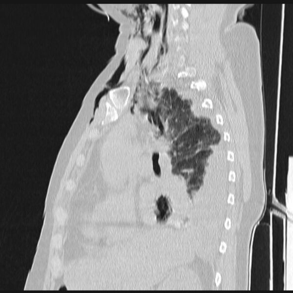 File:Boerhaave syndrome (Radiopaedia 45644-49799 Sagittal lung window 31).jpg