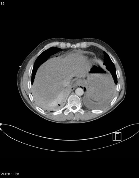 File:Boerhaave syndrome with tension pneumothorax (Radiopaedia 56794-63605 A 40).jpg