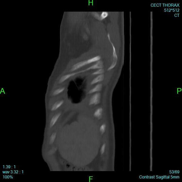 File:Bone metastases from lung carcinoma (Radiopaedia 54703-60937 Sagittal bone window 53).jpg