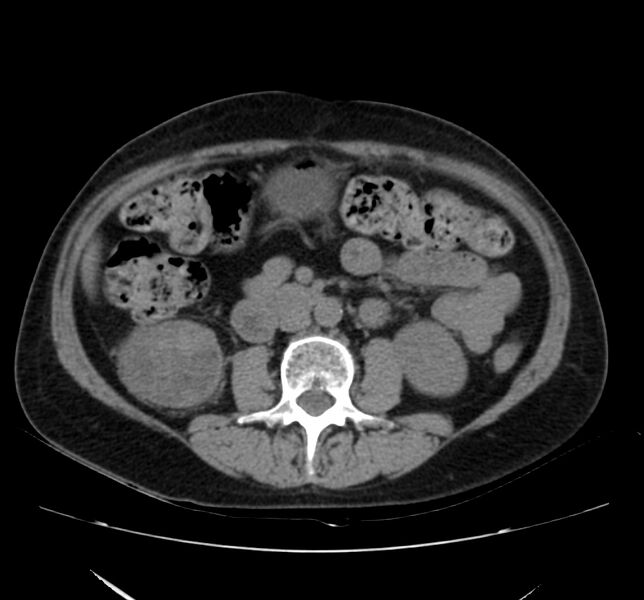 File:Bosniak renal cyst - type IV (Radiopaedia 22929-22953 Axial non-contrast 28).jpg