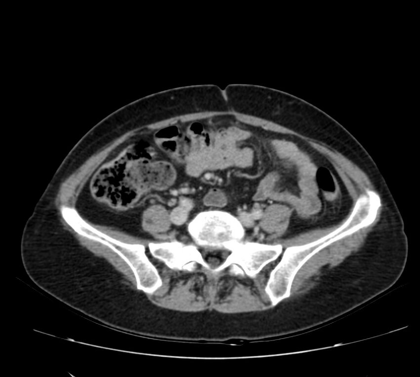 Bosniak renal cyst - type IV (Radiopaedia 22929-22953 C 45).jpg