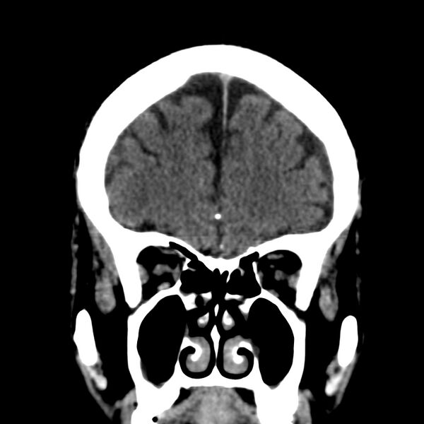File:Brain Pantopaque remnants (Radiopaedia 78403-91048 Coronal non-contrast 18).jpg