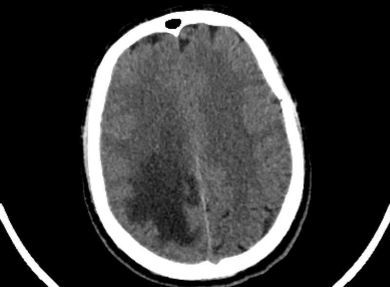 File:Brain abscess complicated by intraventricular rupture and ventriculitis (Radiopaedia 82434-96575 Axial non-contrast 82).jpg