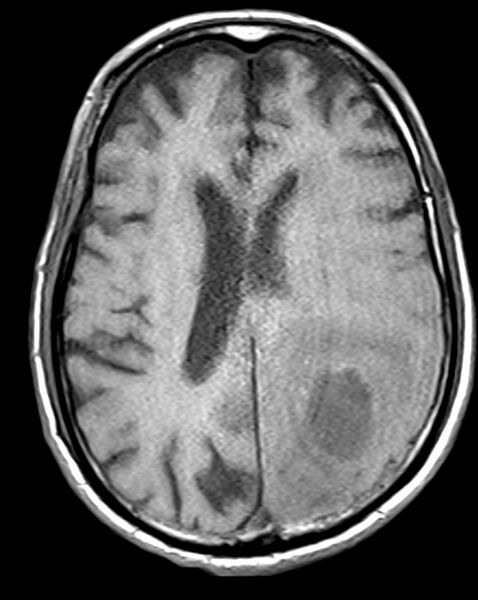 File:Brain abscess with dual rim sign (Radiopaedia 87566-103938 Axial T1 15).jpg