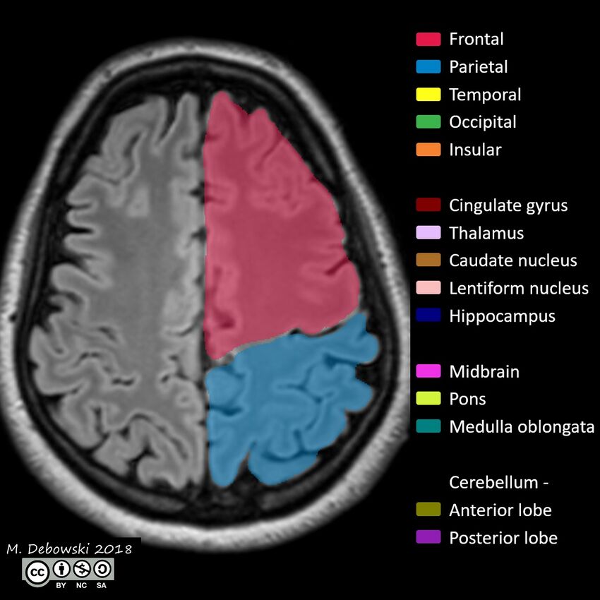 Brain lobes - annotated MRI (Radiopaedia 61691-69700 Axial 18).JPG