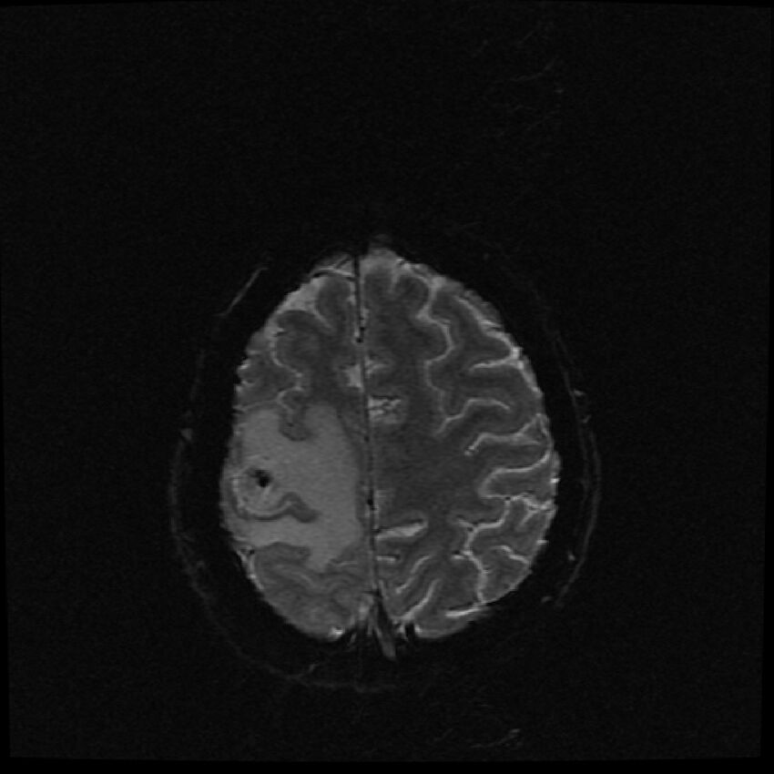 Brain metastases (renal cell carcinoma) (Radiopaedia 42571-45704 Axial SWI 7).jpg