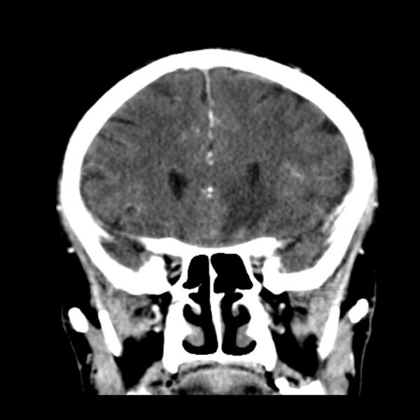 File:Brain metastases from lung cancer (Radiopaedia 24480-24781 Coronal C+ delayed 20).jpg