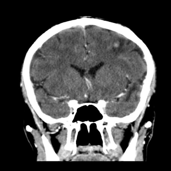 File:Brain metastases from lung cancer (Radiopaedia 24480-24781 Coronal C+ delayed 23).jpg