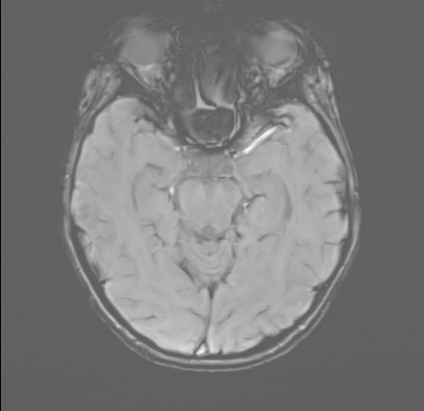 Brainstem glioma (Radiopaedia 70548-80674 Axial SWI 23).jpg