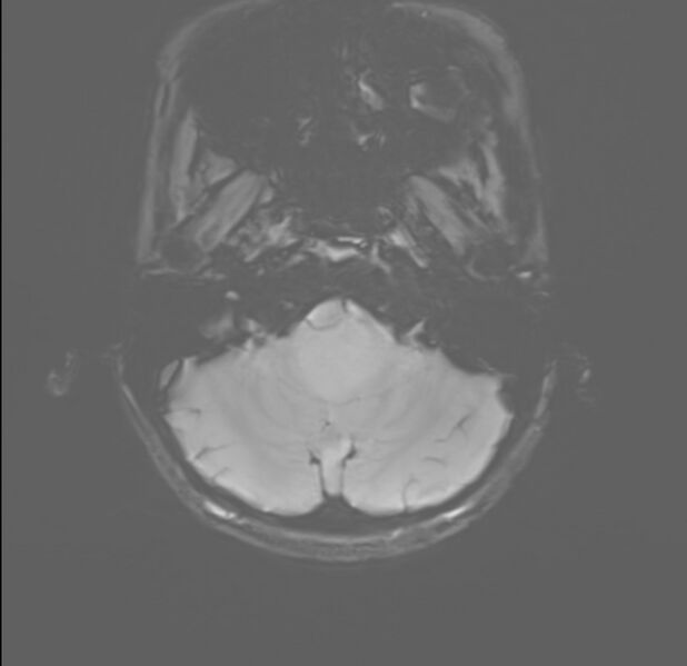 File:Brainstem glioma (Radiopaedia 70548-80674 Axial SWI 5).jpg