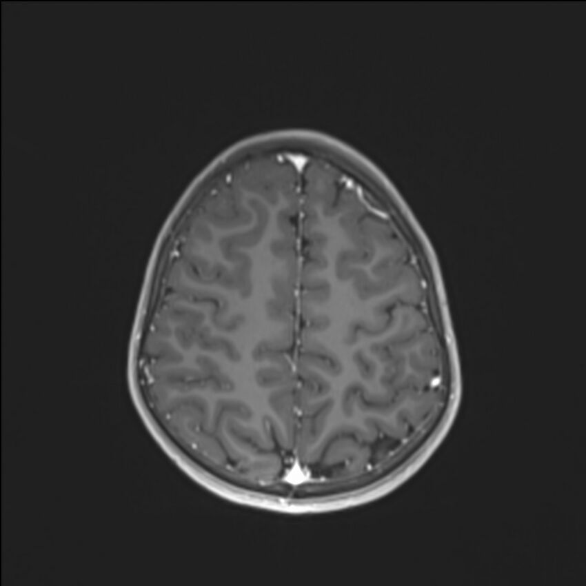 Brainstem glioma (Radiopaedia 70548-80674 Axial T1 C+ 122).jpg