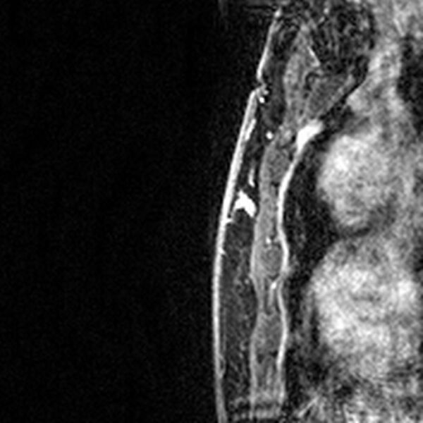 File:Breast implants - MRI (Radiopaedia 26864-27035 Sagittal T2 76).jpg