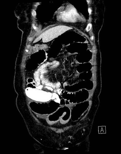 File:Broad ligament hernia (Radiopaedia 84802-100276 B 61).jpg