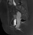Broad ligament leiomyoma (Radiopaedia 81634-95516 G 18).jpg