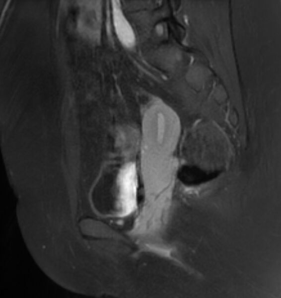 File:Broad ligament leiomyoma (Radiopaedia 81634-95516 G 18).jpg