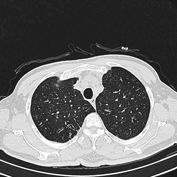 File:Bronchiectasis (Radiopaedia 22061-22059 lung window 6).jpg