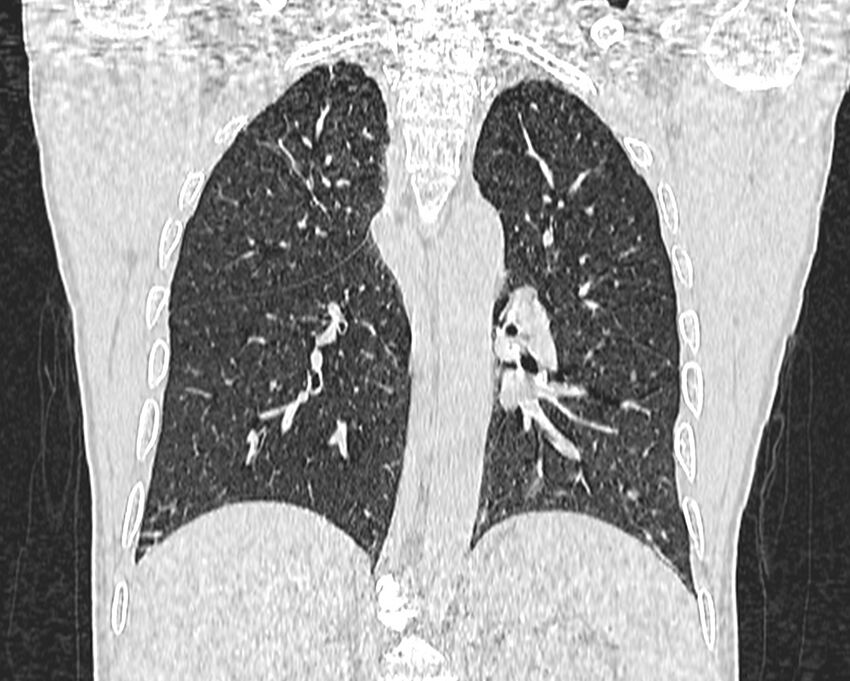 Bronchogenic carcinoma with superior vena cava syndrome (Radiopaedia 36497-38054 Coronal lung window 67).jpg