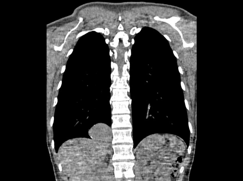 Bronchogenic cyst (Radiopaedia 80273-93615 D 95).jpg