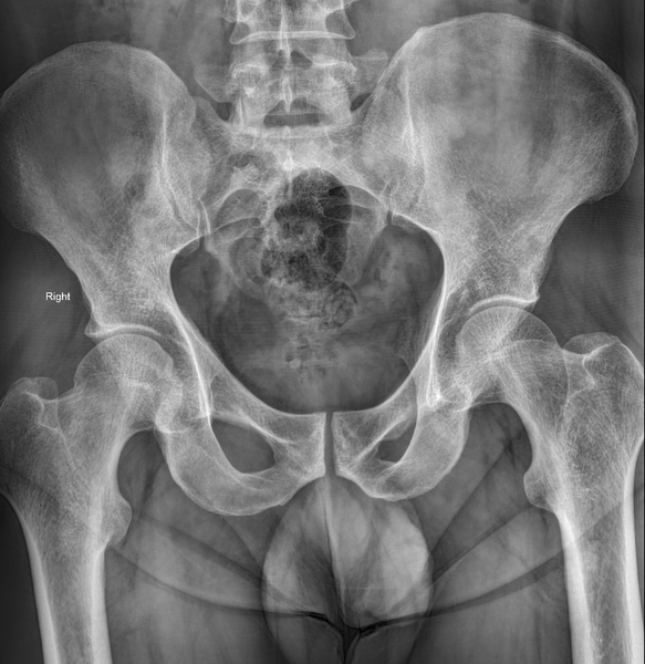 File:Bulbar urethral stricture (Radiopaedia 62859-71229 non-contrast 1).PNG