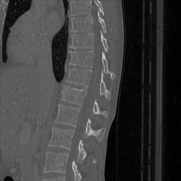 File:Bulging of paraspinal line in traumatic thoracal spinal compression fracture (Radiopaedia 29221-35872 Sagittal bone window 21).jpg