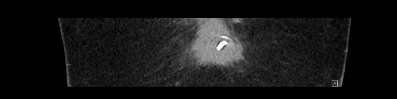 File:Buried bumper syndrome - gastrostomy tube (Radiopaedia 63843-72575 Coronal Inject 18).jpg