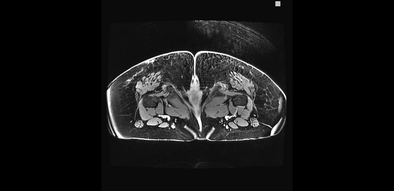 File:Buttock filler complications (Radiopaedia 63497-72115 Axial T1 C+ 55).jpg