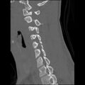 C5 facet fracture (Radiopaedia 58374-65499 Sagittal bone window 31).jpg