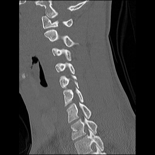 File:C5 facet fracture (Radiopaedia 58374-65499 Sagittal bone window 31).jpg