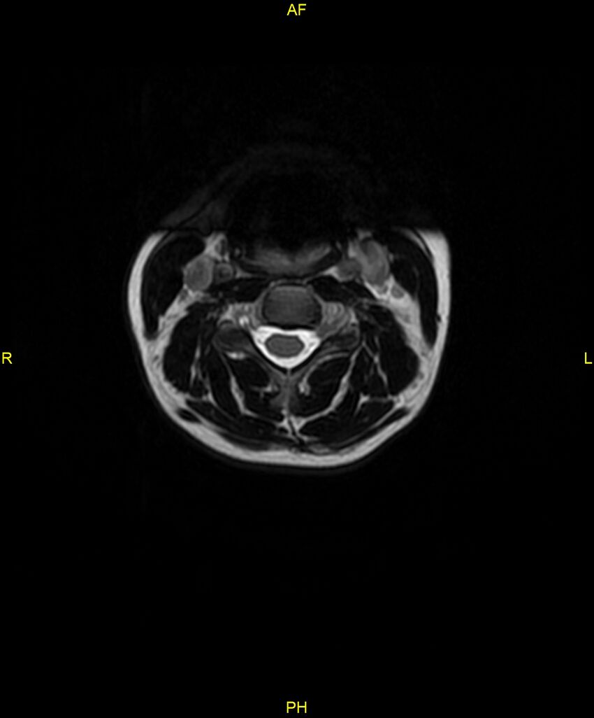 C5 nerve sheath tumor (Radiopaedia 85777-101596 Axial T2 21).jpg