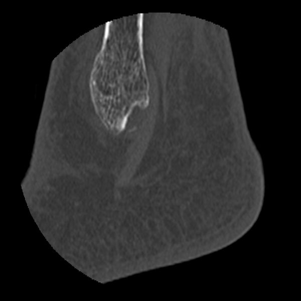 File:Calcaneal tuberosity avulsion fracture (Radiopaedia 22649-22668 D 1).jpg